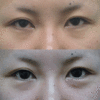 lateral canthoplasty down before and after.gifのサムネール画像